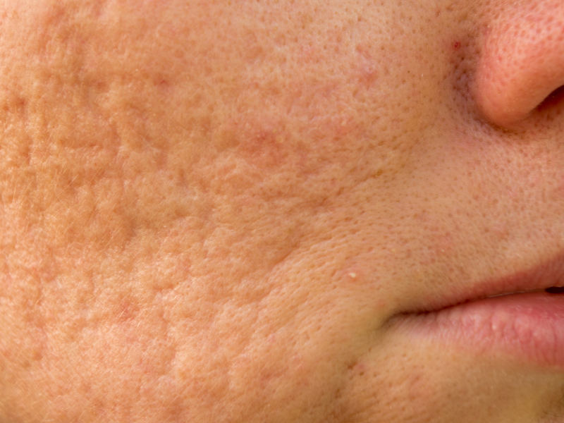 Close-up of acne scars and uneven skin texture on cheek