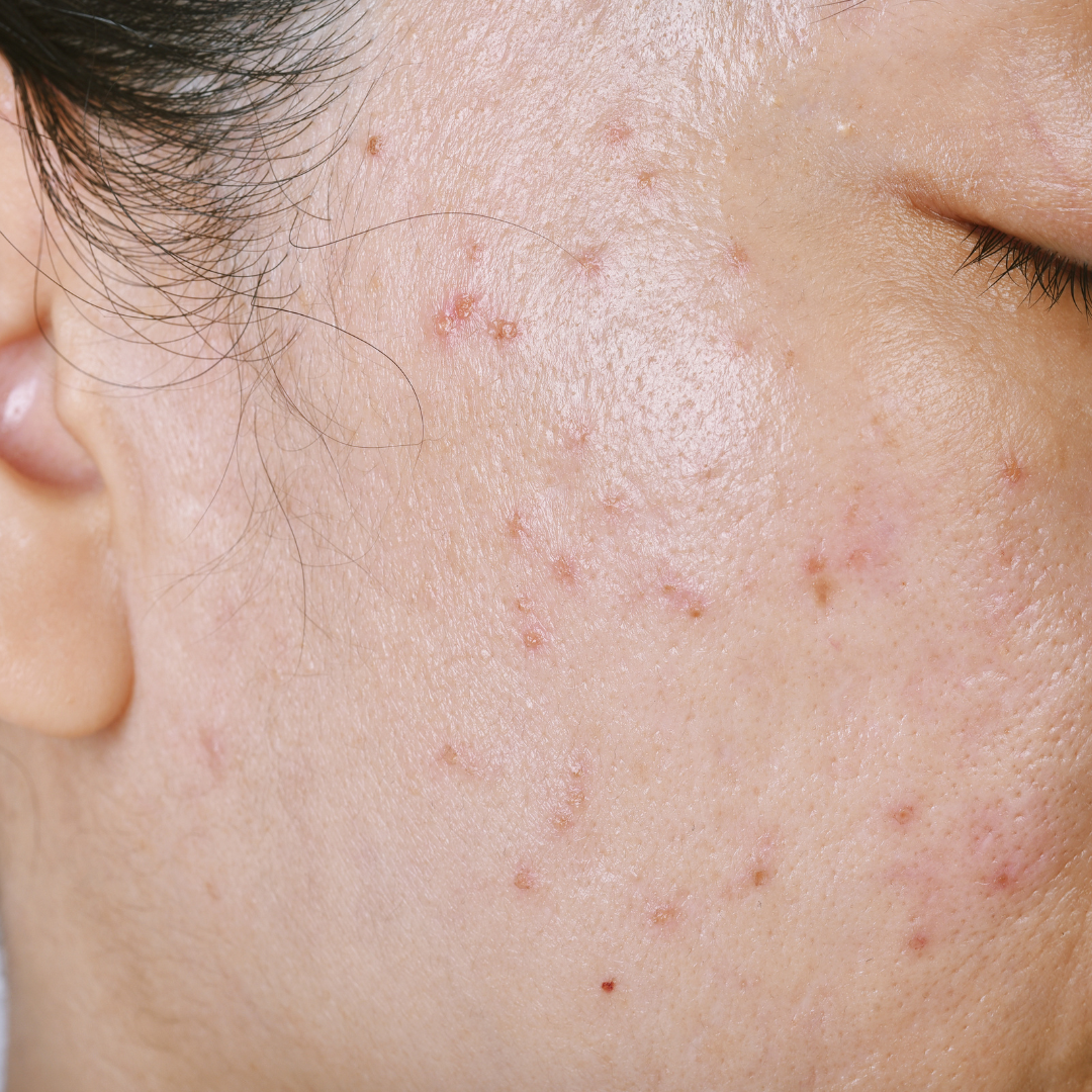 Acne Scar Treatments