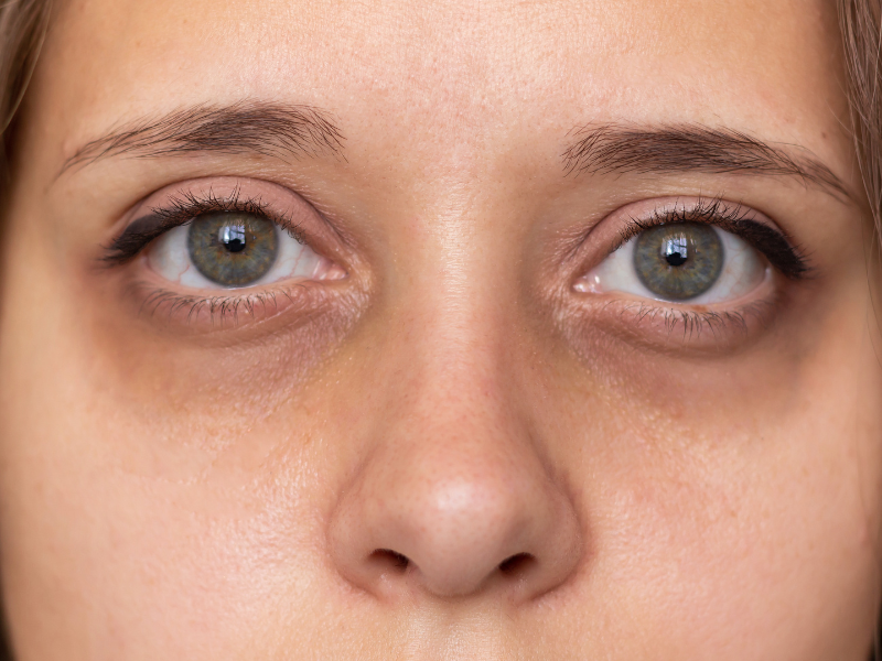 Close-up of a woman's eyes with noticeable dark circles