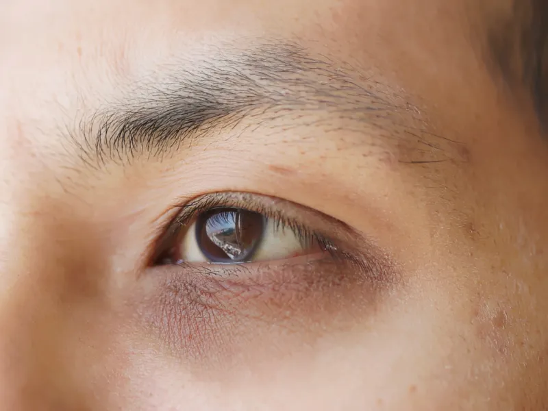 Close-up of a person's eye with visible dark under-eye circles