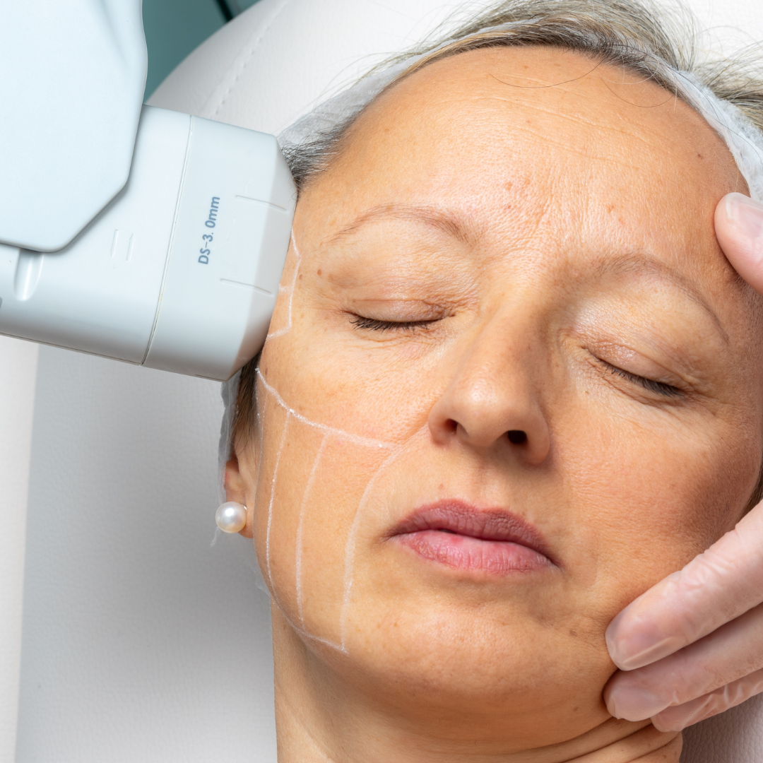 HIFU For Acne Scars