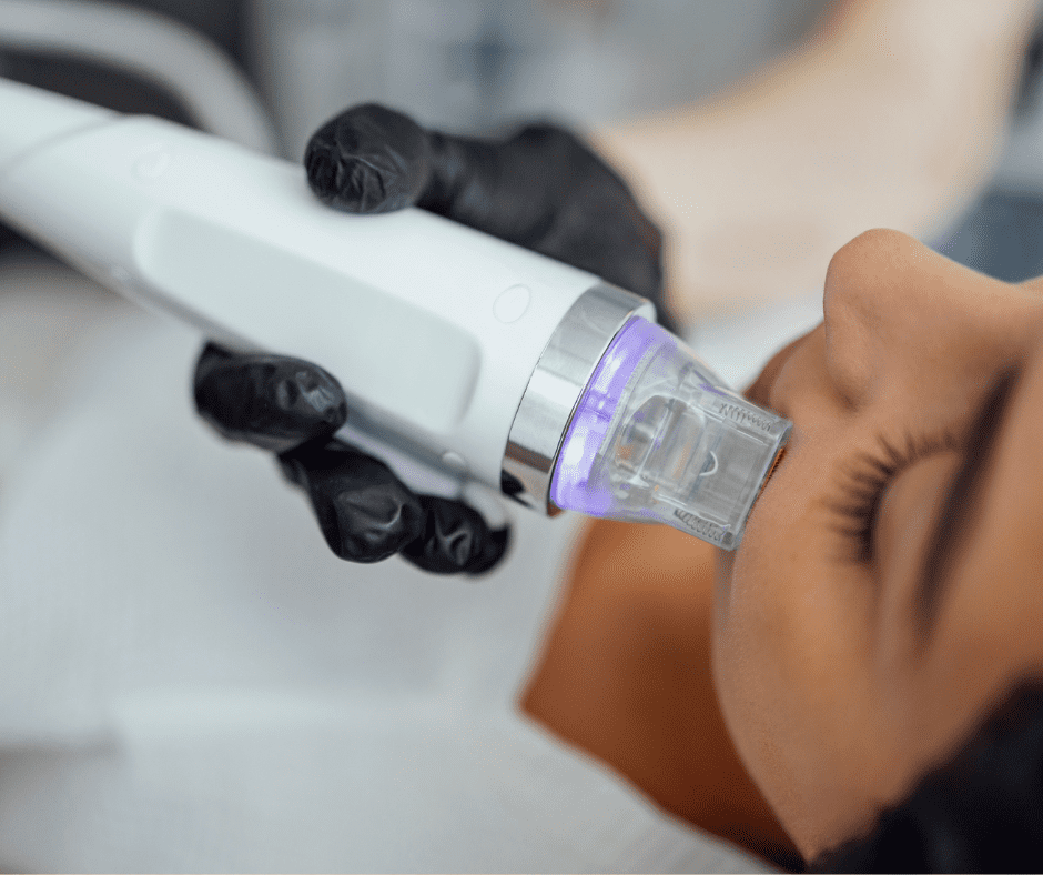 Magic of RF Microneedling