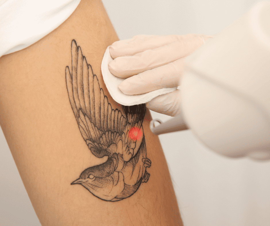 Tattoo Removal After Care