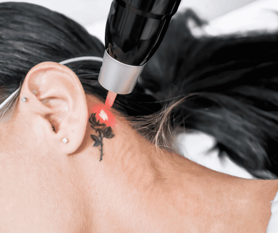Tattoo Removal Cost