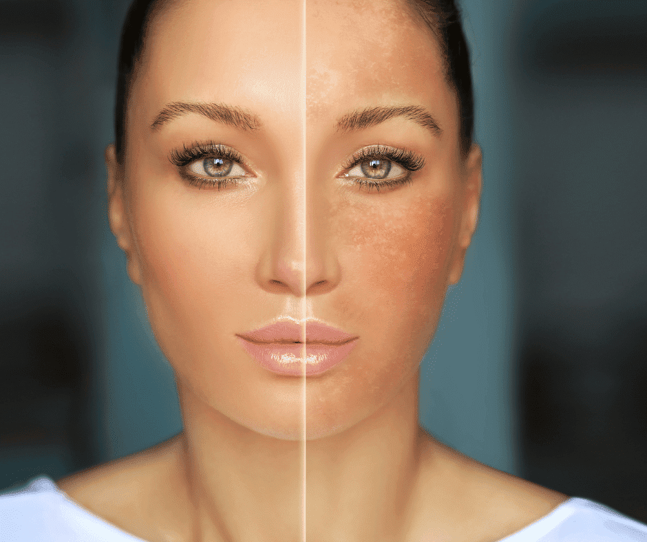 Hyperpigmentation Myths vs Reality