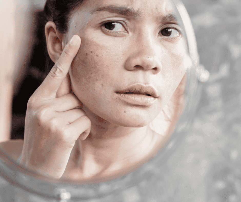 Science Behind Chemical Peels