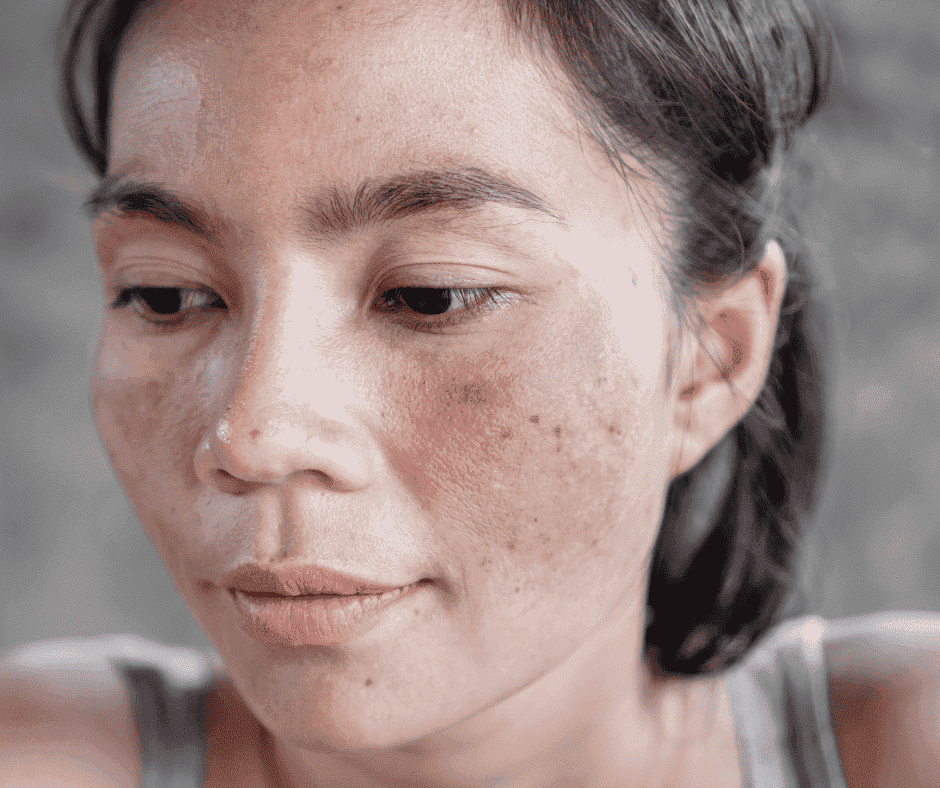 Melasma and Chemical Peels FAQs