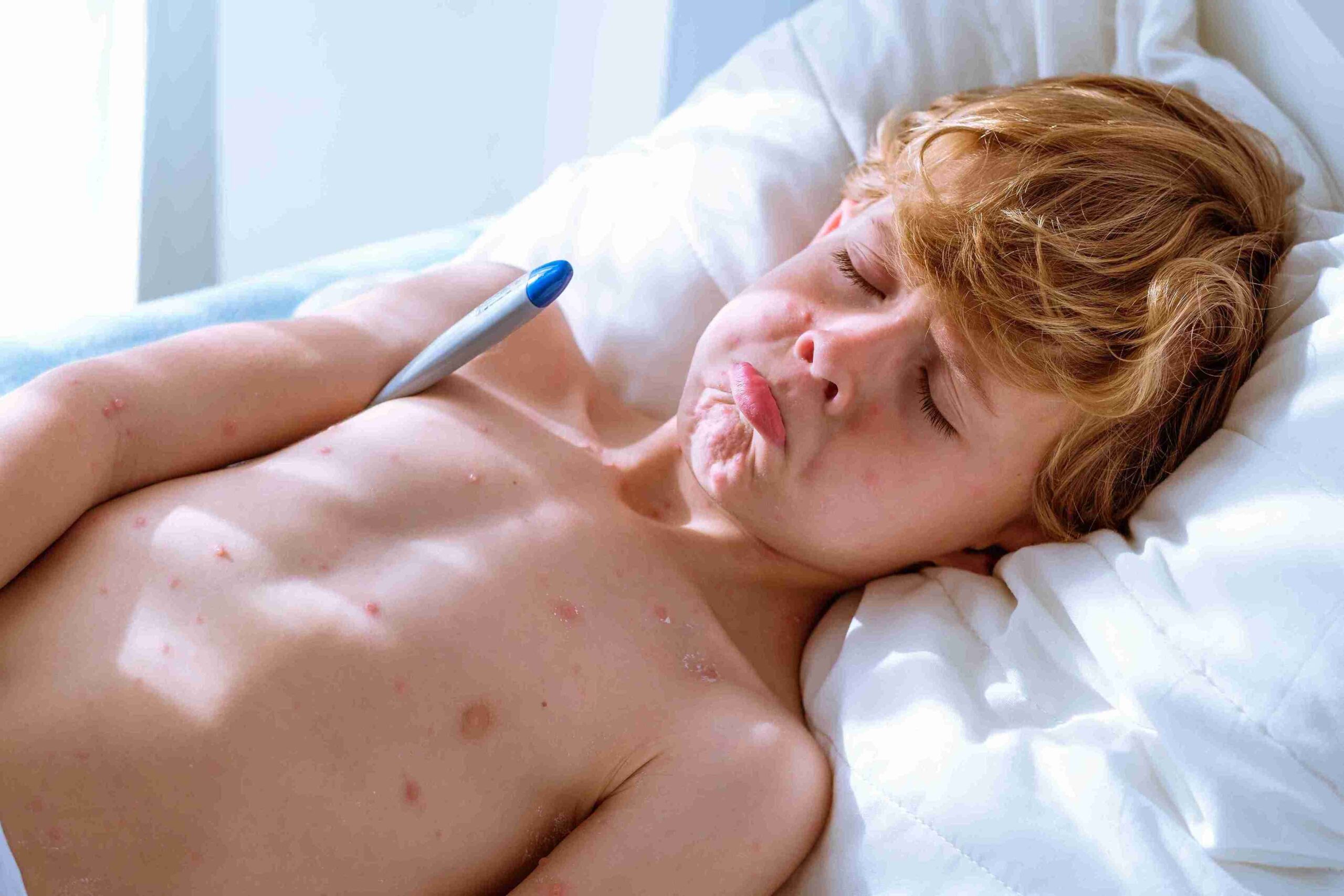 child with chicken pox lying in bed