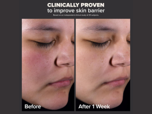 Before and after comparison of skin improvement using Paula's Choice exfoliant